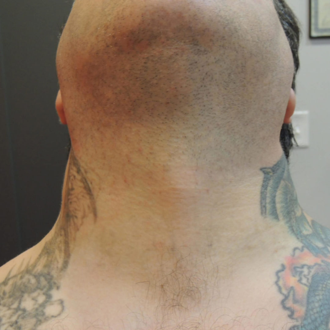 renewal-laser-premier-laser-tattoo-removal-and-skincare